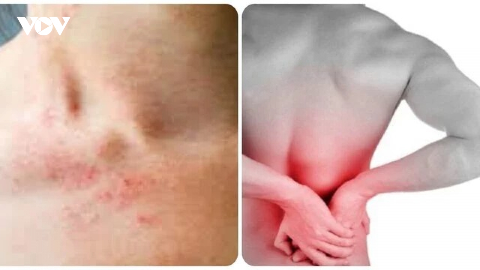 Triệu chứng suy thận nhẹ bạn cần biết