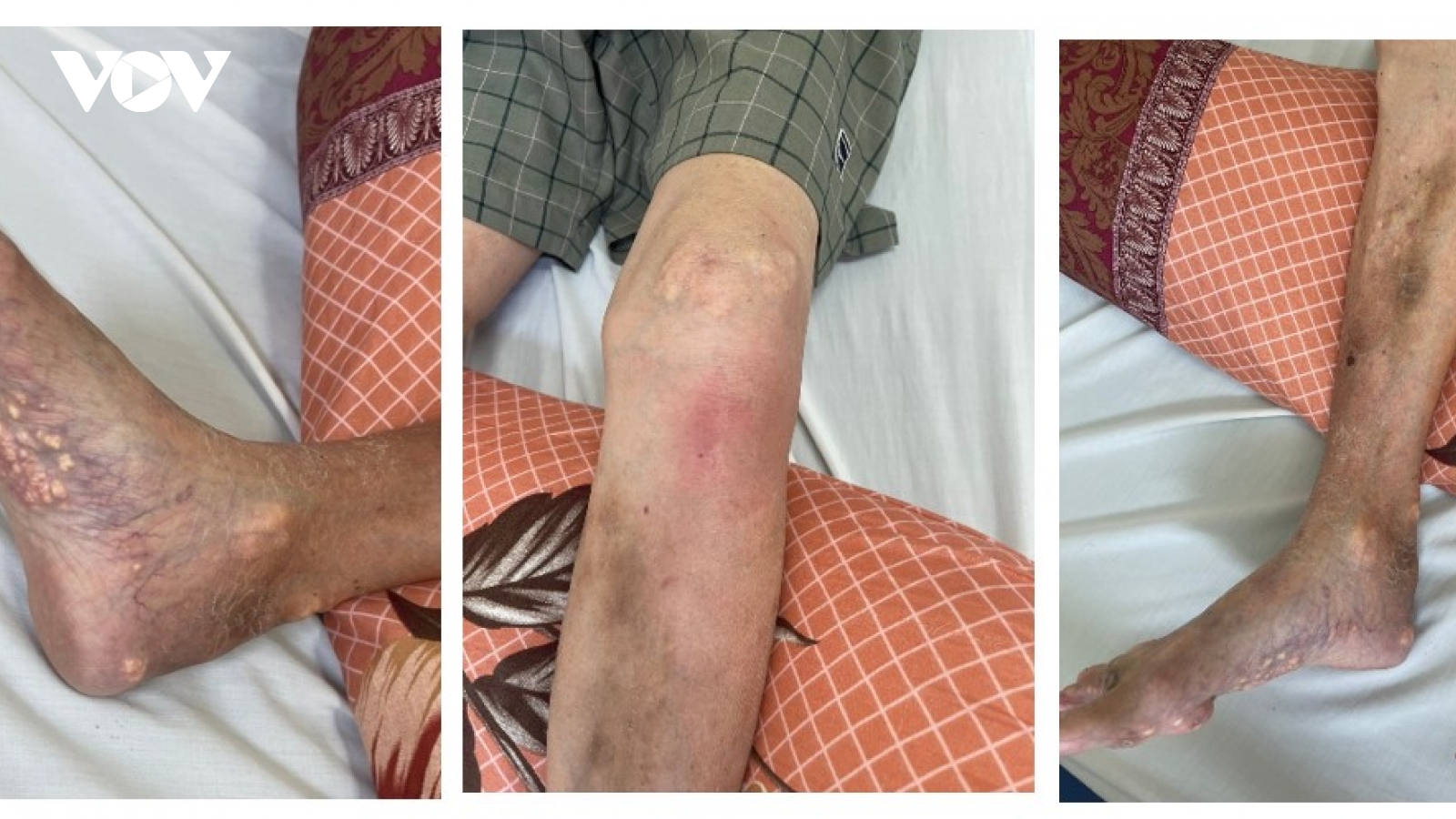 Nguy cơ tàn phế từ thói quen tự ý dùng Corticoid trị gút