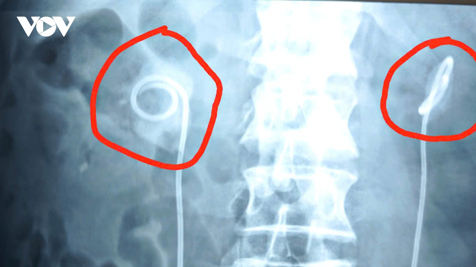 Bệnh nhân “quên” sonde JJ 2 năm, suýt ngừng tim vì biến chứng nặng