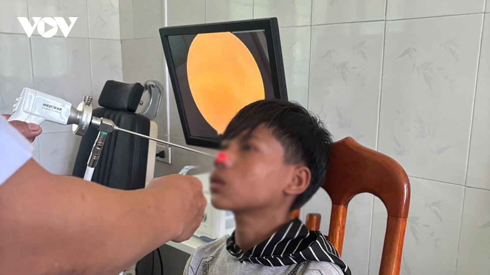 Con đỉa dài khoảng 4cm trong mũi một bệnh nhân ở Quảng Trị