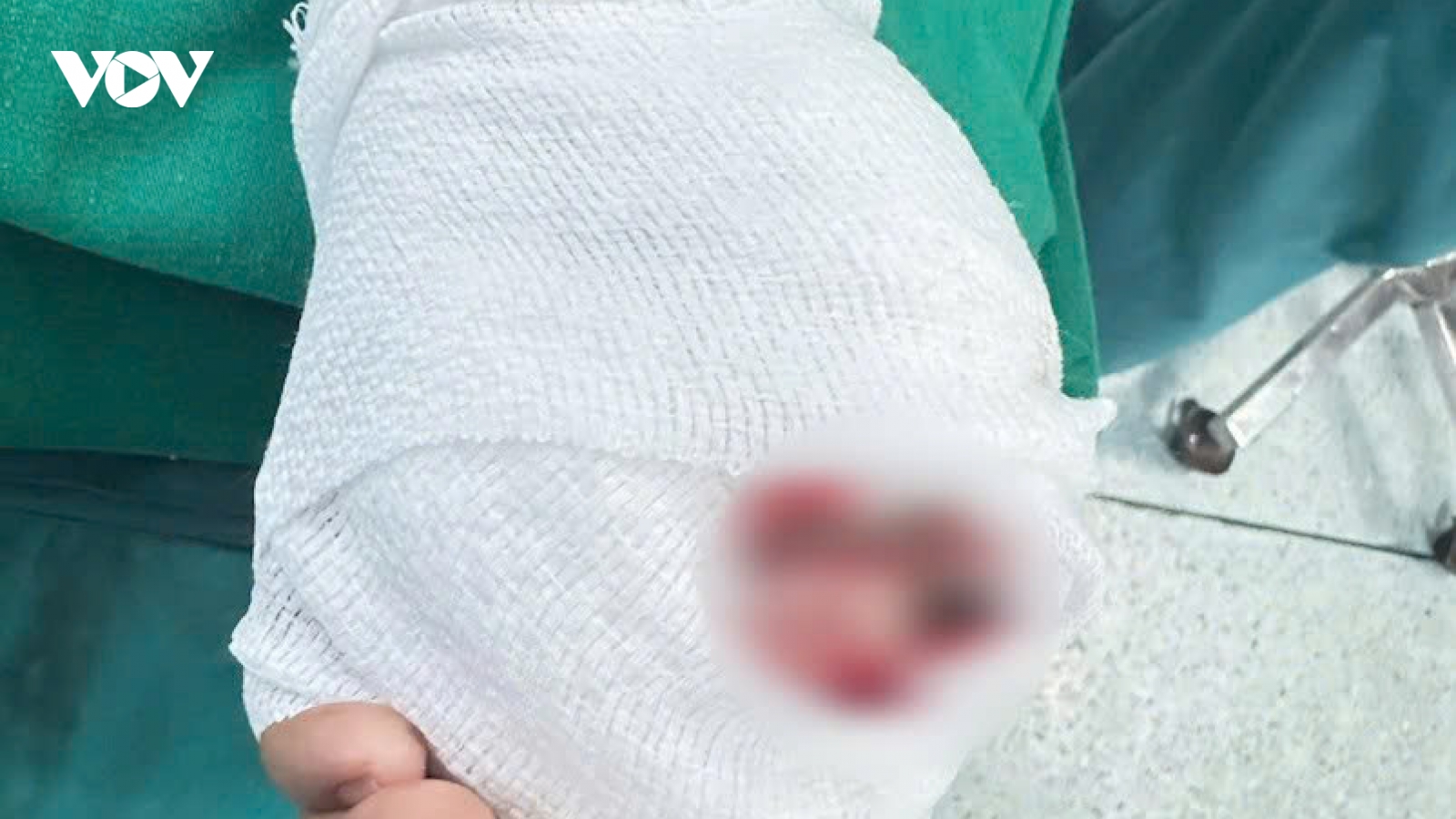 Nối lại ngón tay bị đứt gần lìa cho bé trai 5 tuổi nhờ kỹ thuật vi phẫu