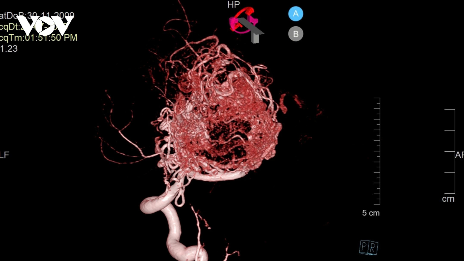 Cứu sống bệnh nhân 16 tuổi dị dạng mạch máu não do đau đầu kéo dài