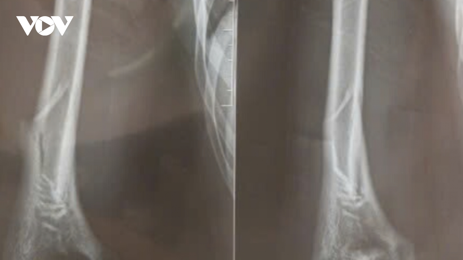 Vật tay vui, hậu quả nặng: Nam thanh niên gãy xương cánh tay