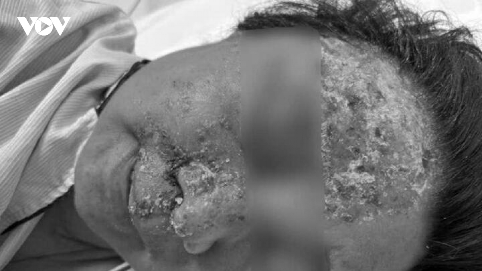 Nổi mụn nước tưởng dị ứng da, không ngờ nhiễm virus gây biến chứng nguy hiểm