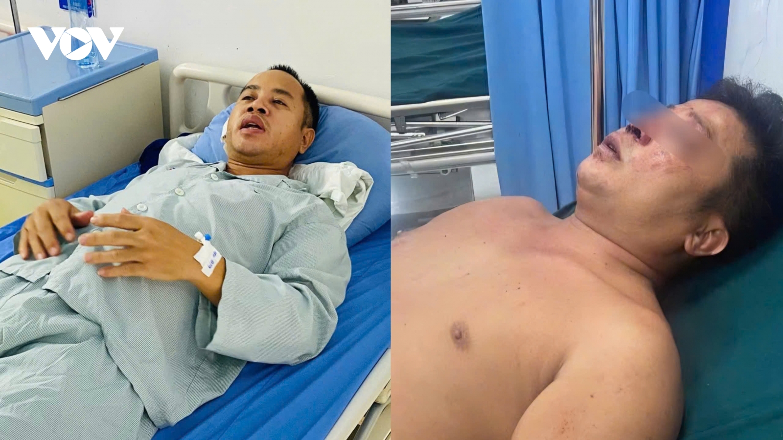 Bị đánh khi giúp người: Hai anh em nhập viện với đa chấn thương, vỡ hốc mắt