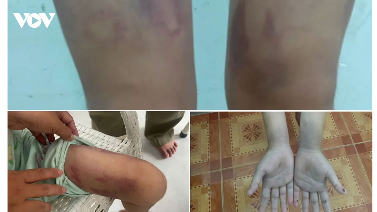 Đang giám định thương tích bé gái 9 tuổi ở TP.HCM bị mẹ ruột và bạn trai bạo hành