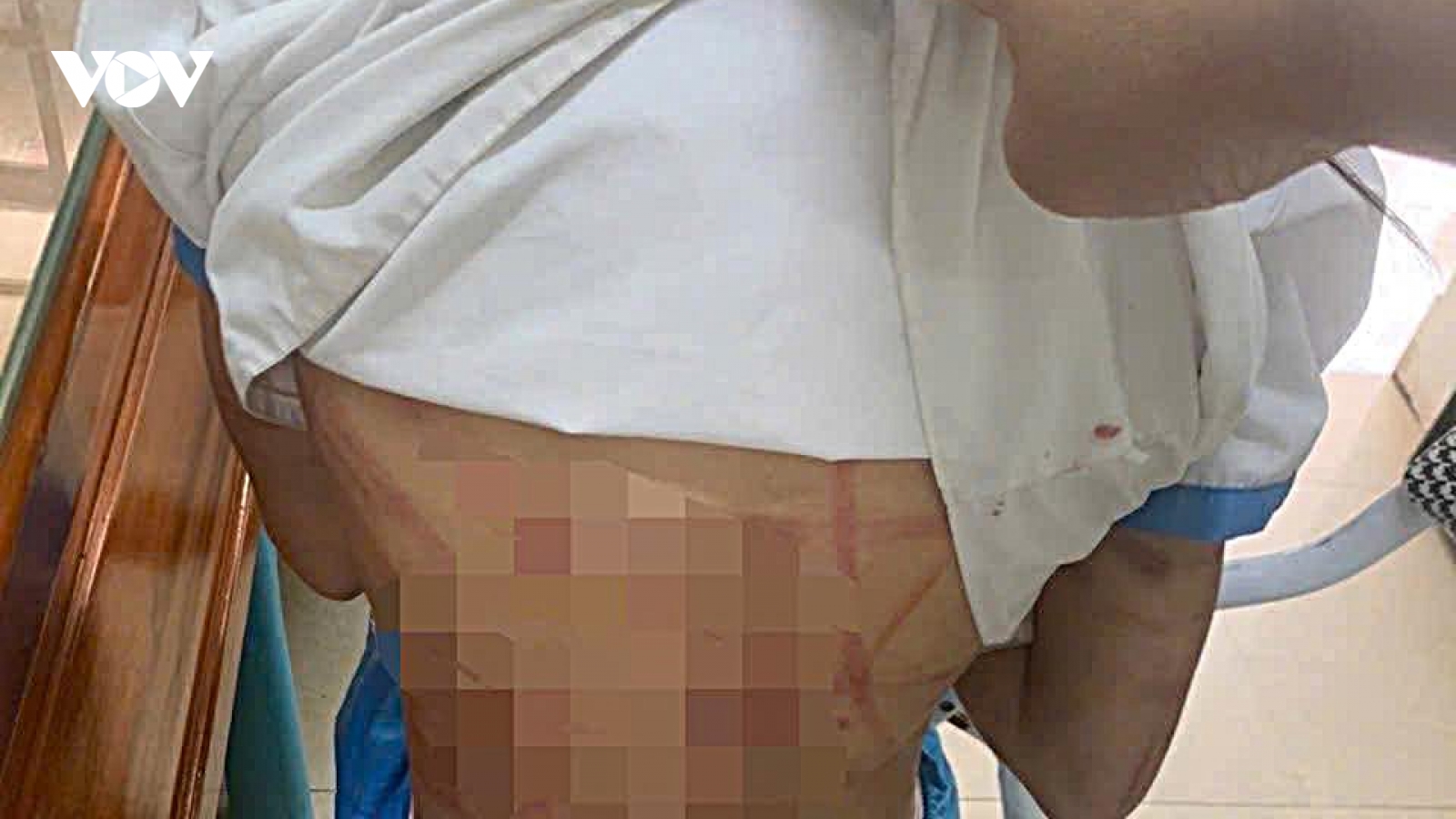 Bé gái nhập viện nghi do cha dượng hành hung