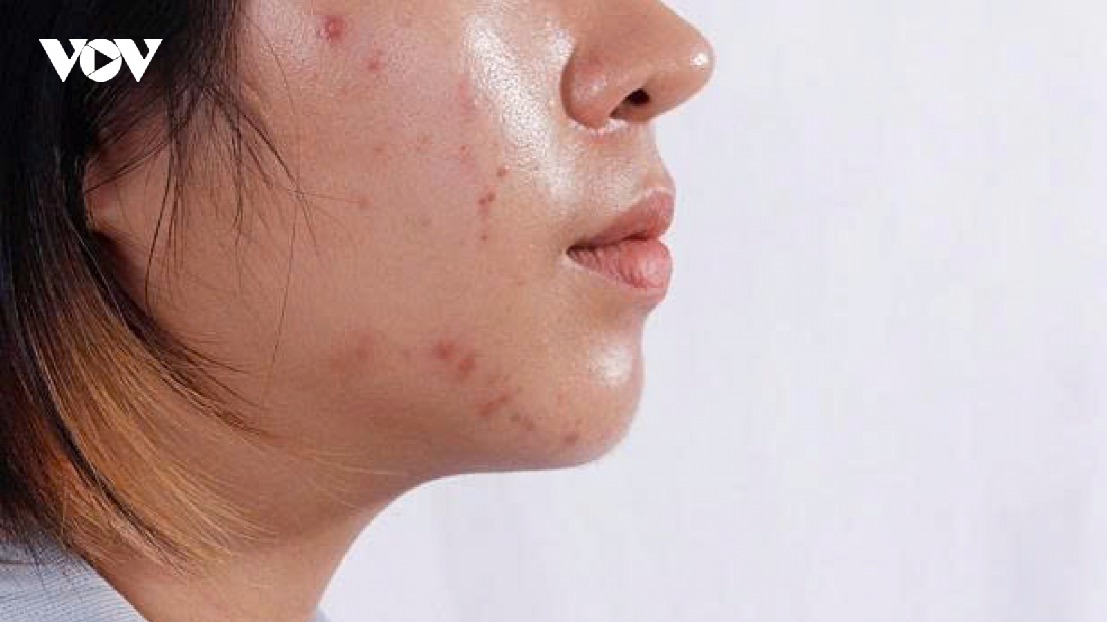 Cách làm sạch dầu trên da mặt an toàn và hiệu quả