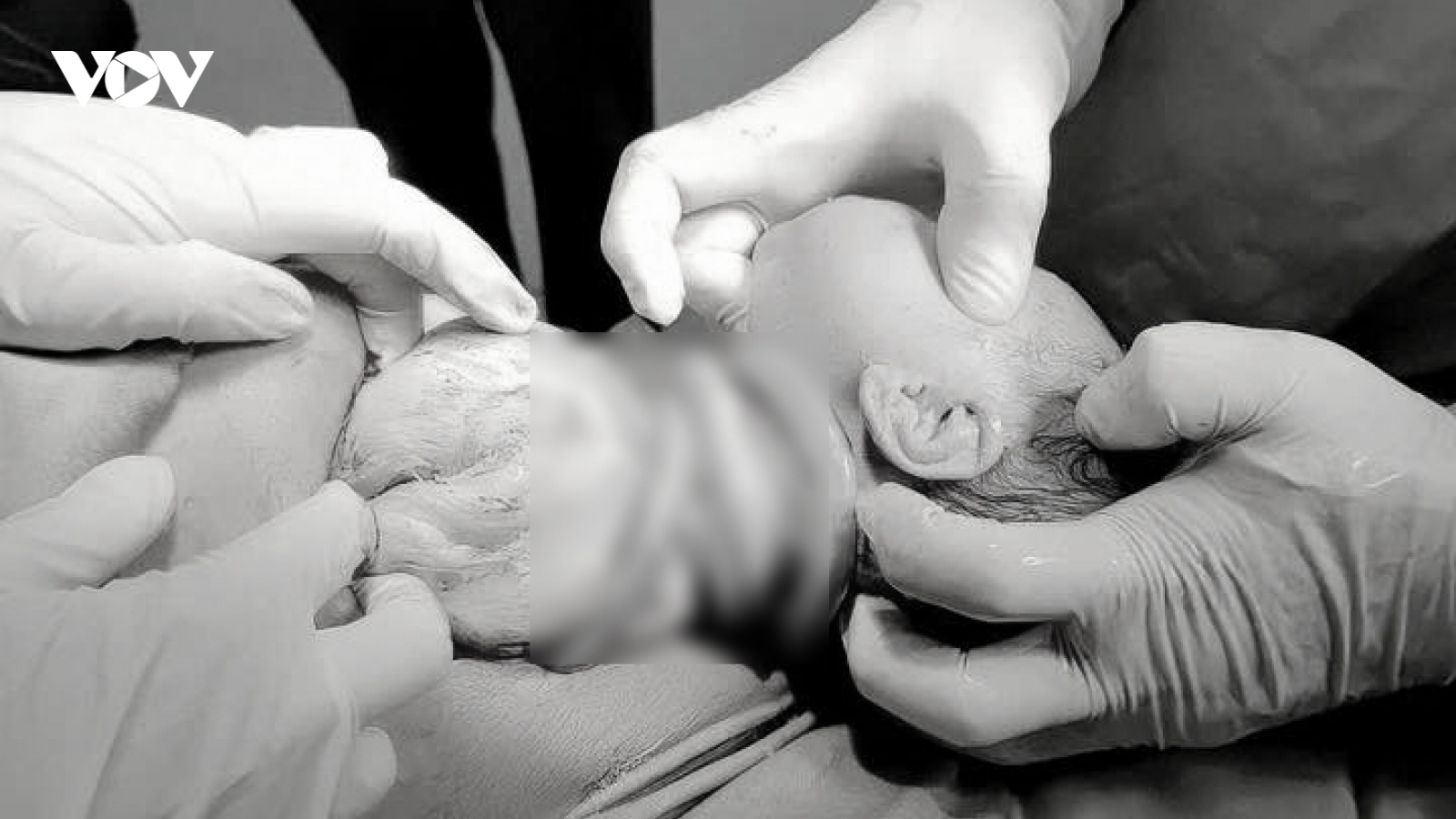 Bé gái chào đời với 6 vòng dây rốn quấn cổ, mẹ tiền sản giật
