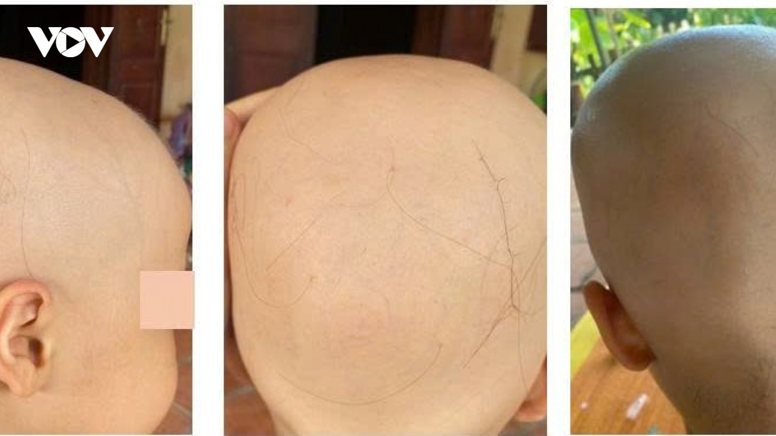 Điều trị thành công rụng tóc toàn thể ở bé 7 tuổi