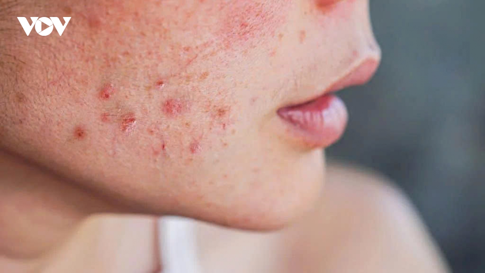 Da nổi mụn do nóng gan? Nên uống gì để thanh lọc và cải thiện làn da
