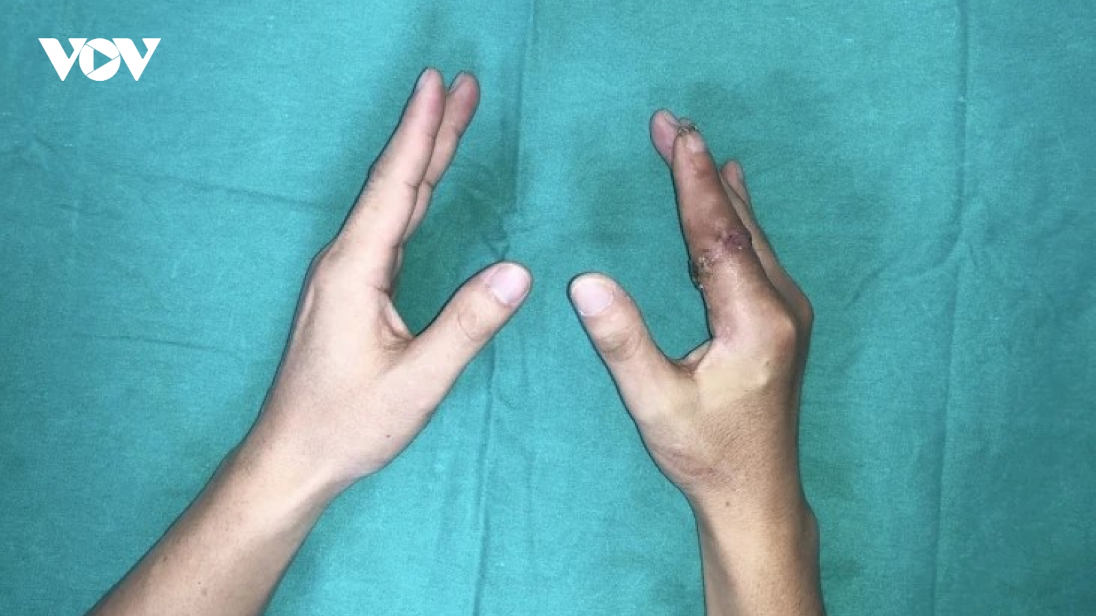Ngón tay thủy thủ "sống lại" sau 25 giờ đứt rời giữa tâm bão