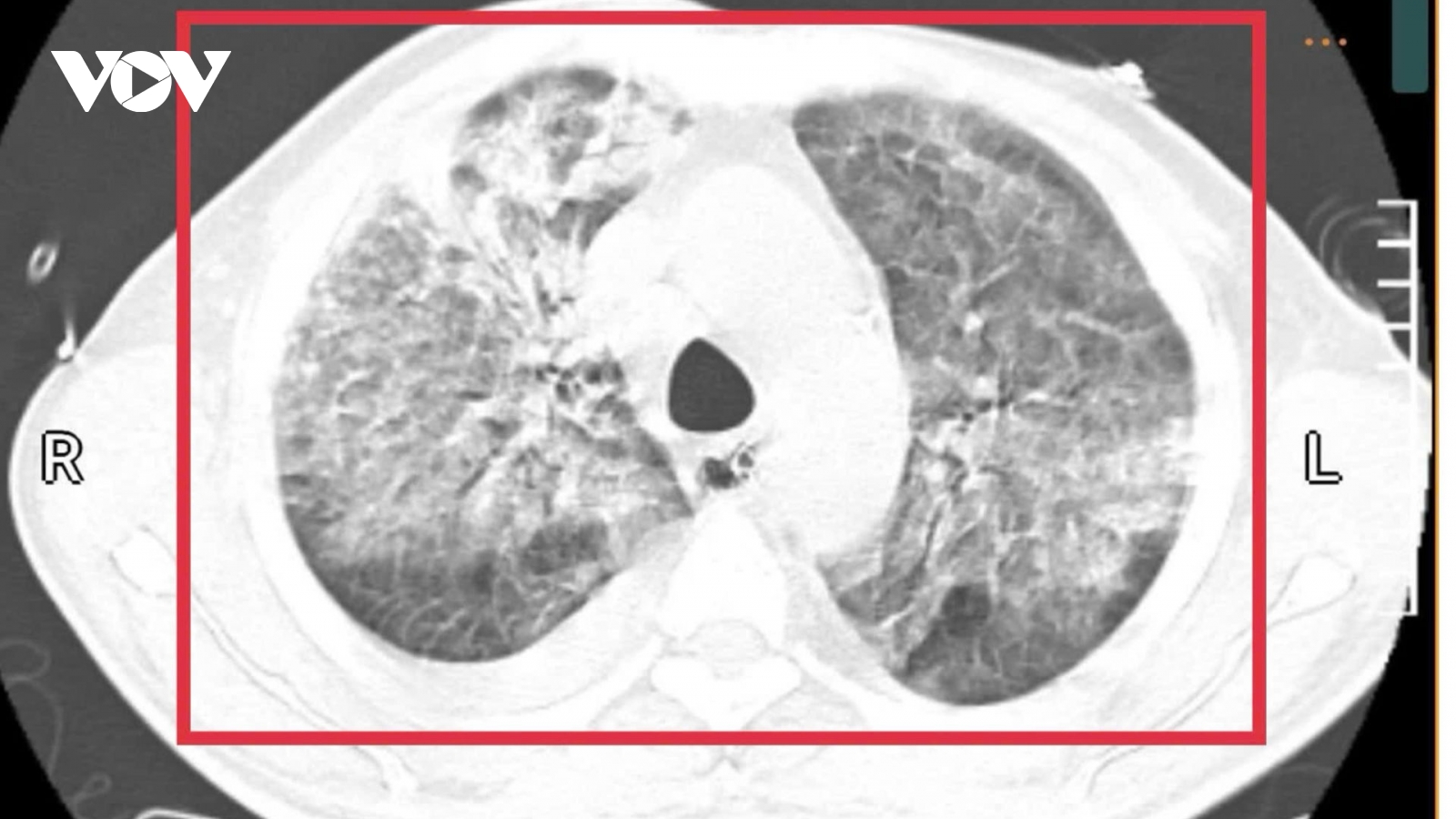 Người đàn ông trở về từ Thái Lan mang theo "vi khuẩn tử thần"