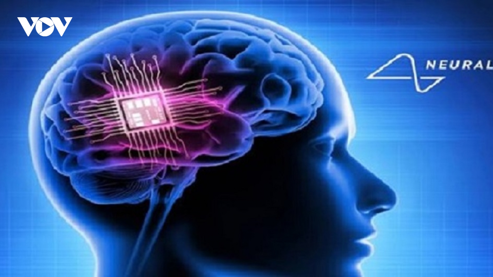Chip não của tỷ phú Musk mở ra hy vọng mới cho bệnh nhân bị liệt