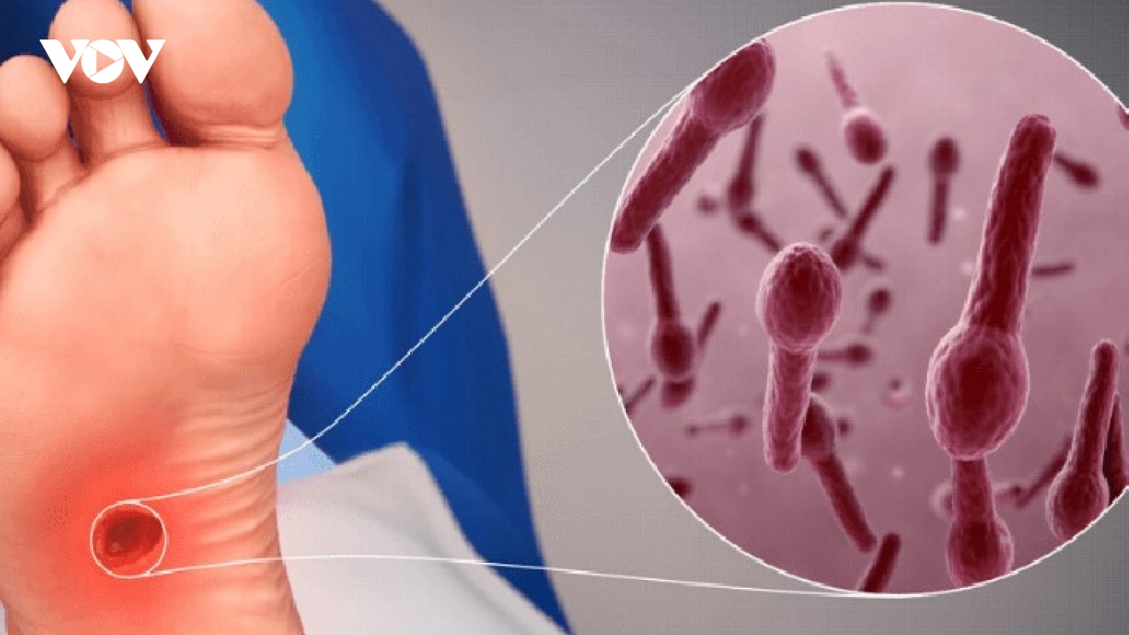 Tôi phải sống chung với mất ngủ kinh niên sau lần chết hụt vì nhiễm uốn ván