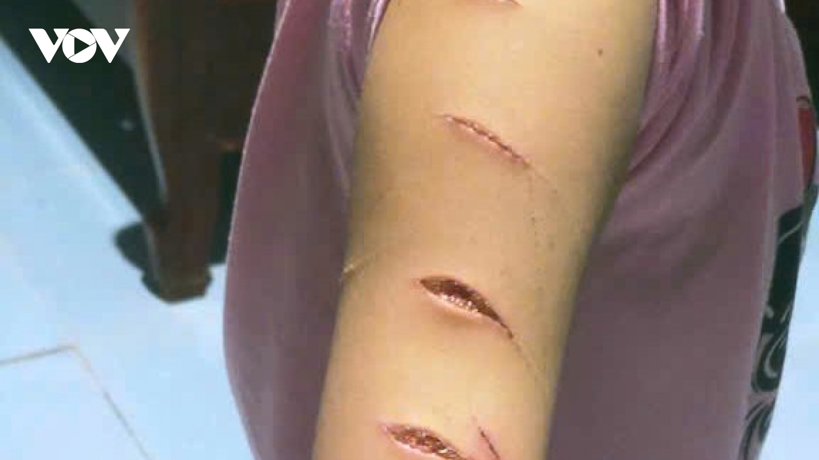 Học sinh lớp 5 bị chị họ cùng tuổi gây thương tích nhiều lần