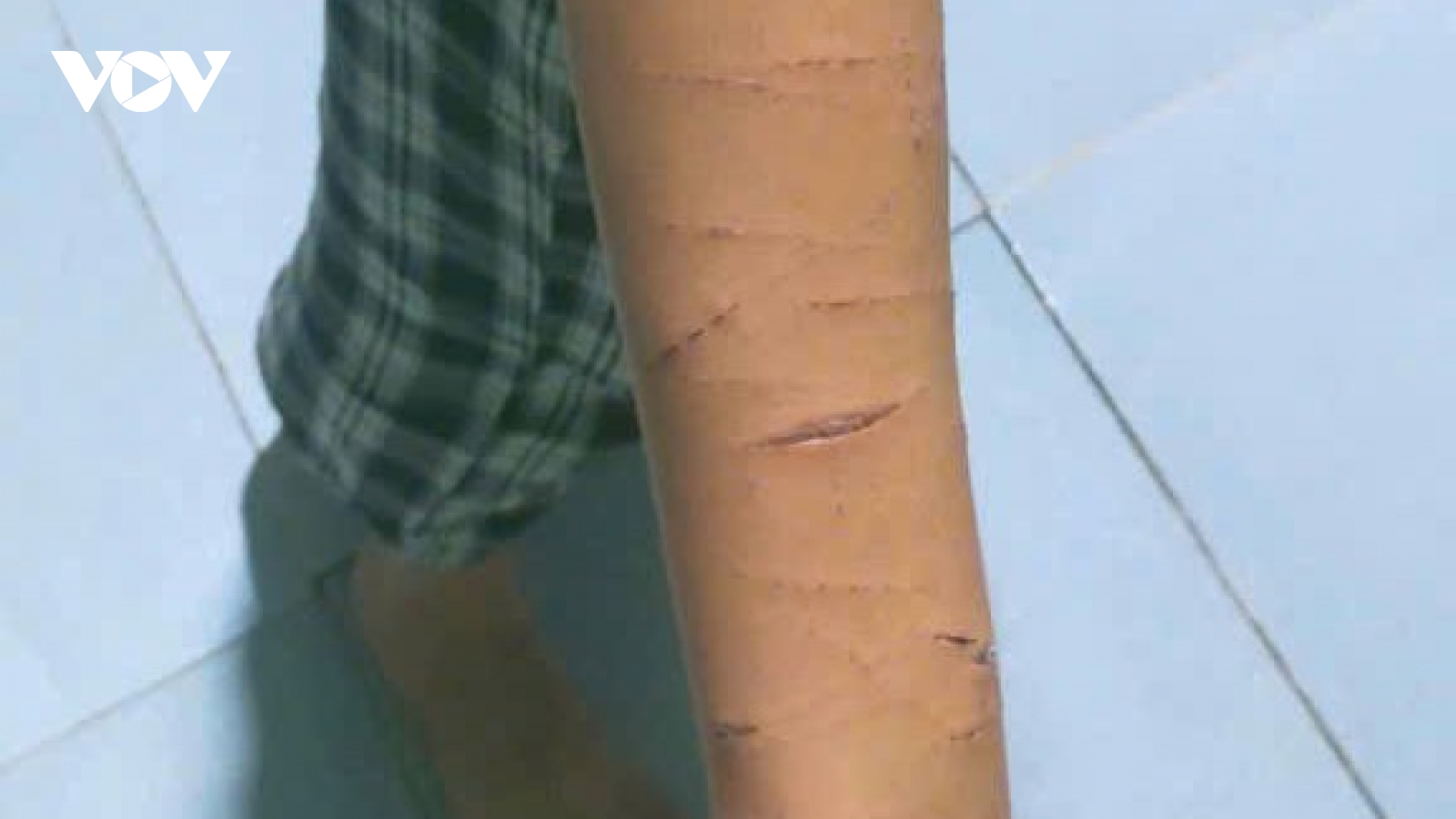 Chỉ đạo xử lý vụ học sinh lớp 5 bị chị họ dùng dao rạch nhiều lần tại Cà Mau