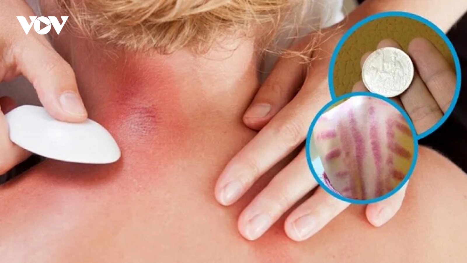 Vì sao đau mỏi người, "trúng gió" dùng đồ bạc, trứng gà để cạo gió?