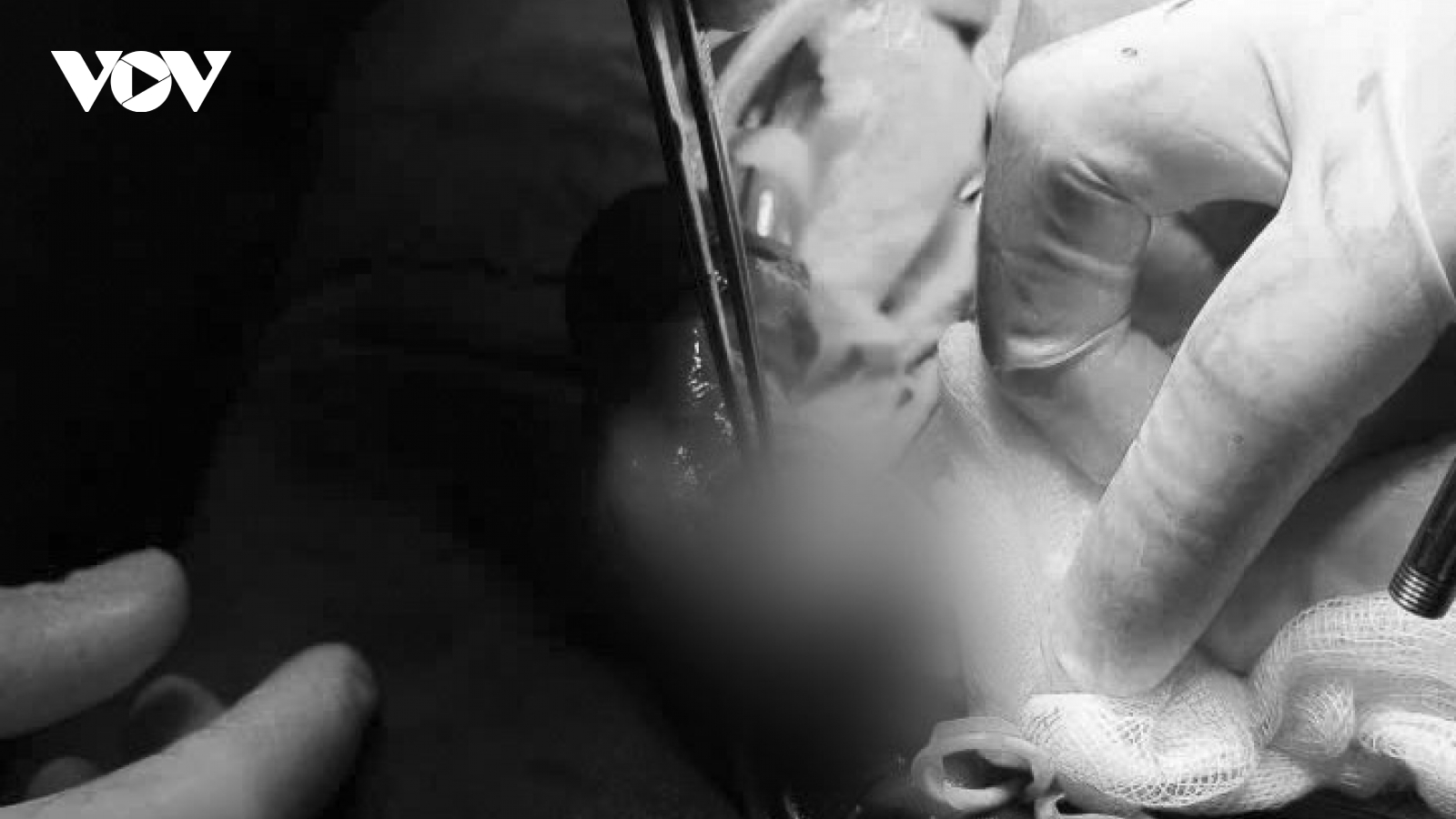 Can thiệp khẩn cấp ca gãy dương vật hy hữu