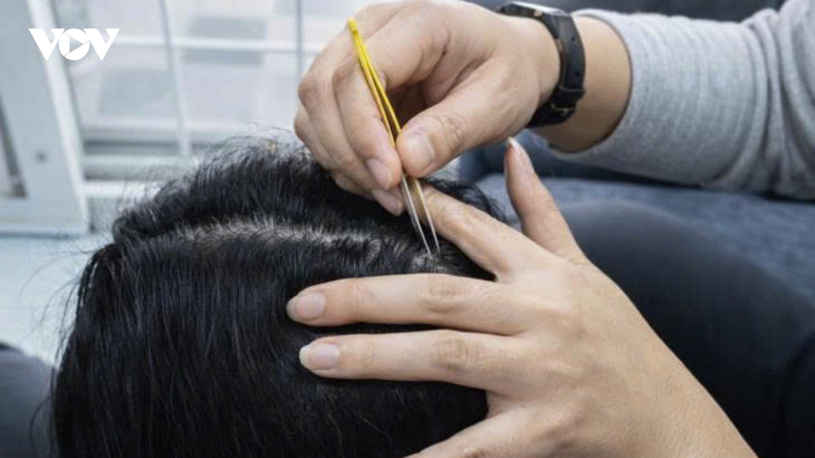 Nhổ tóc bạc cho "đỡ ngứa mắt", coi chừng tóc không mọc lại