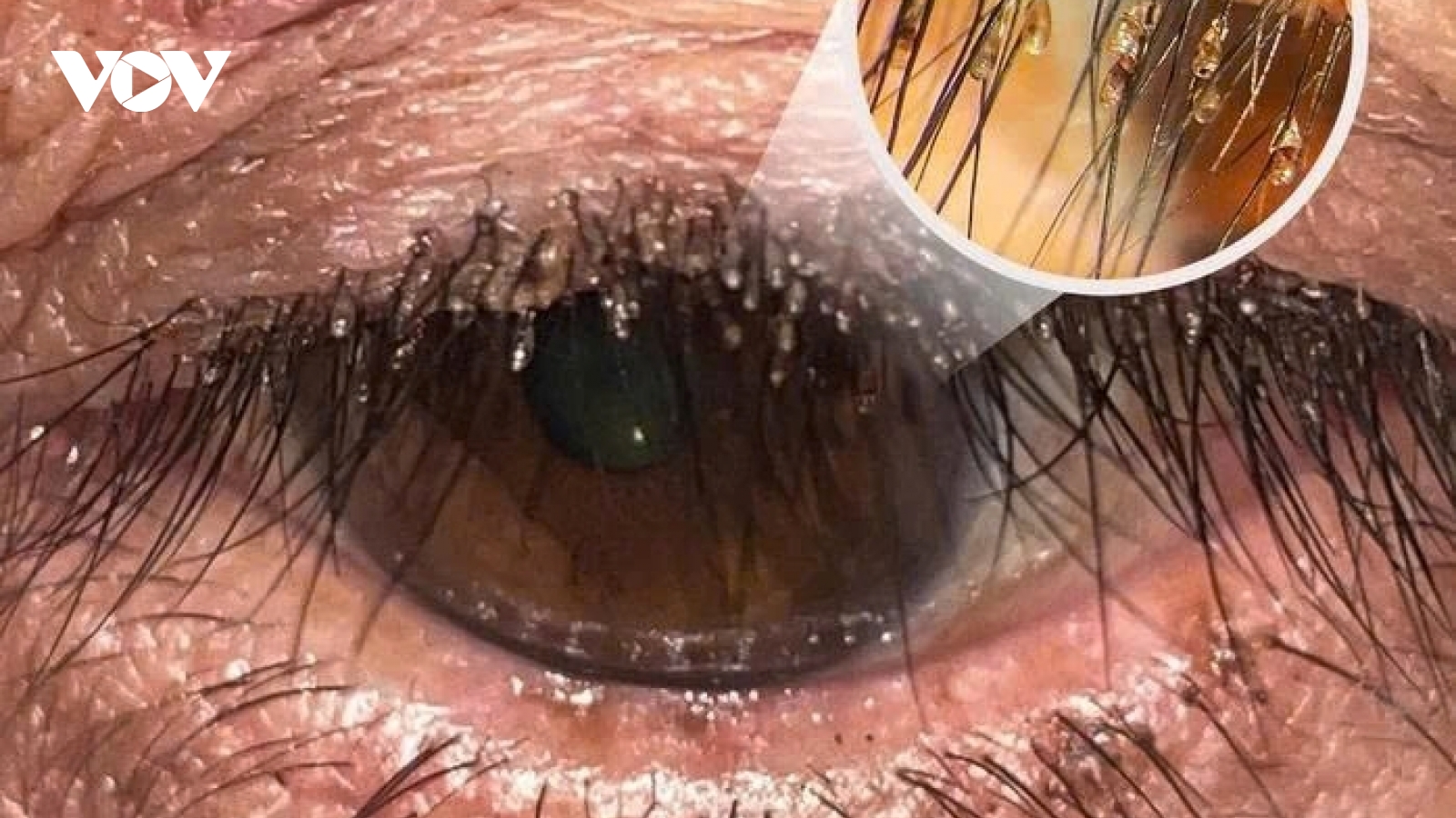 Mắt đau ngứa đi khám, hoảng hốt phát hiện rận mu bám dày đặc trên lông mi