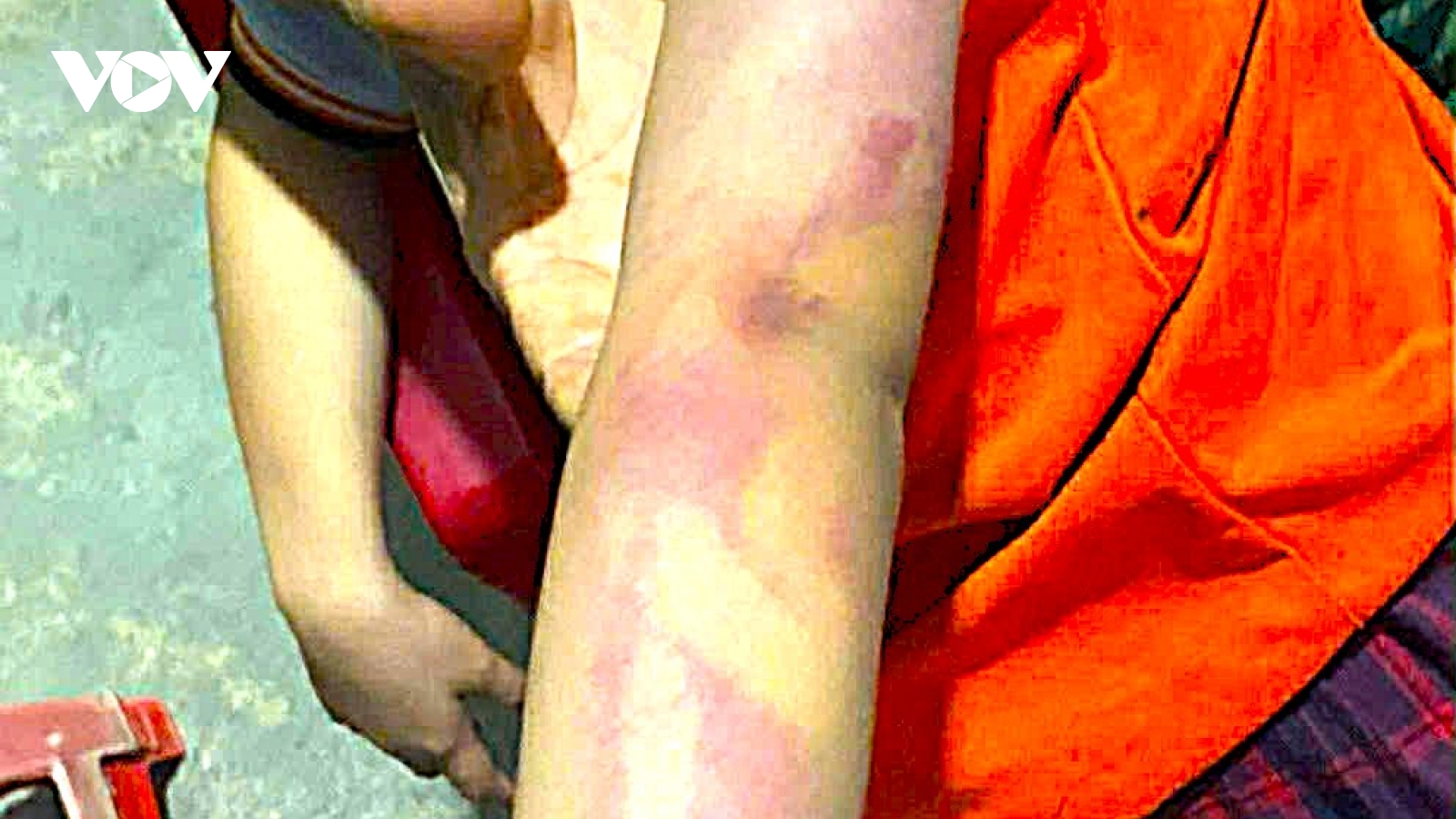 Bé gái lớp 2 ở Hà Tĩnh bị bạn cùng lớp dùng thước đánh bầm tím người