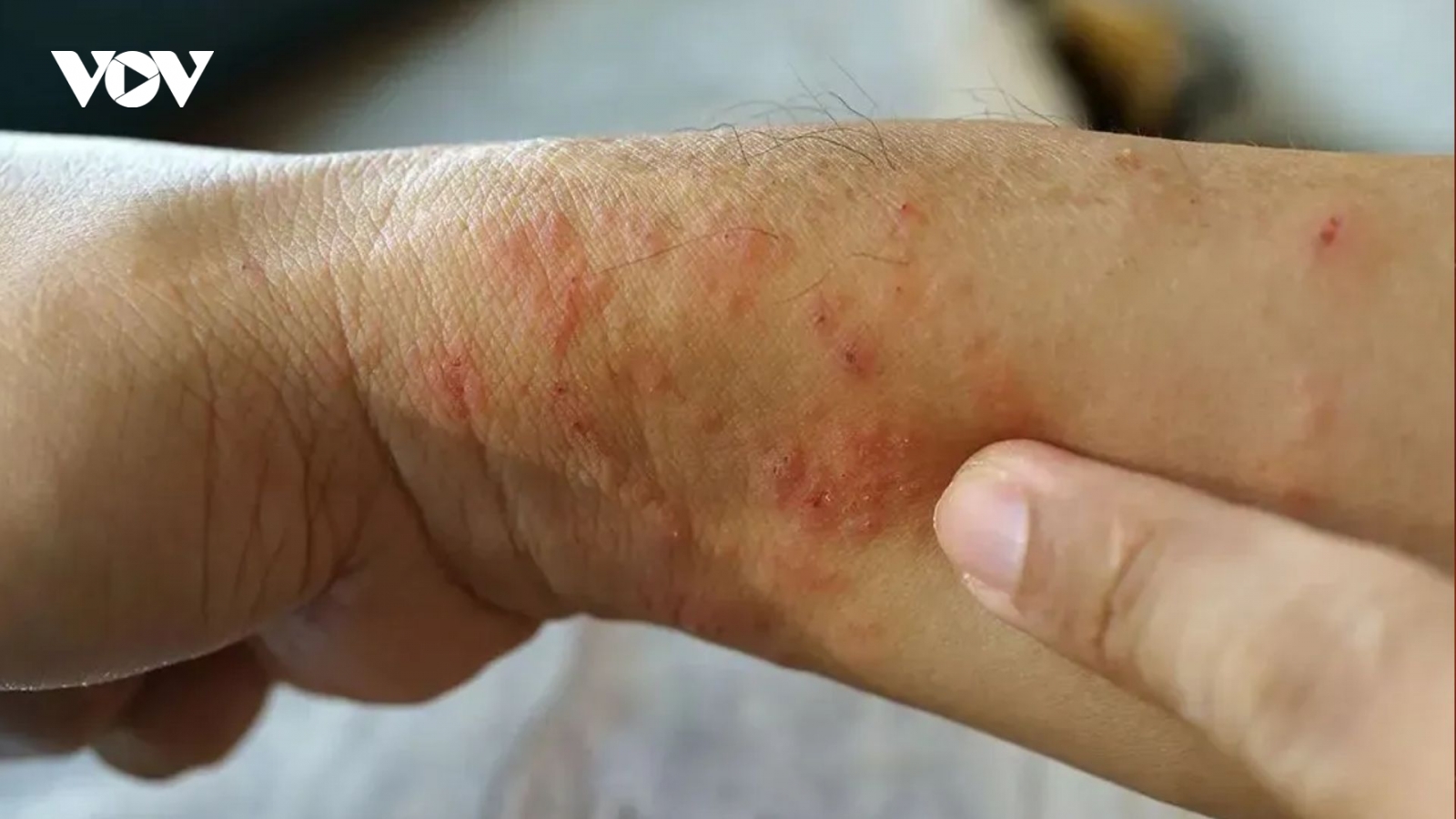 Bệnh "sốt đất" khiến 23 người ở Thái Lan tử vong: Bộ Y tế khuyến cáo