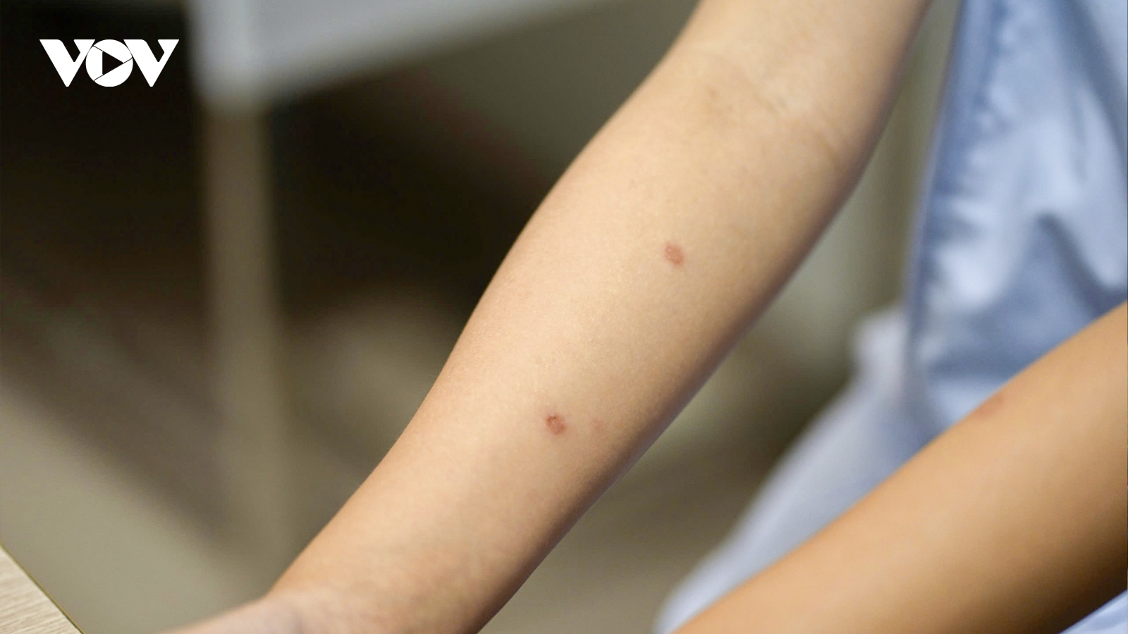 Ôm mèo mỗi ngày, bé gái 14 tuổi trả giá vì nấm da lan rộng