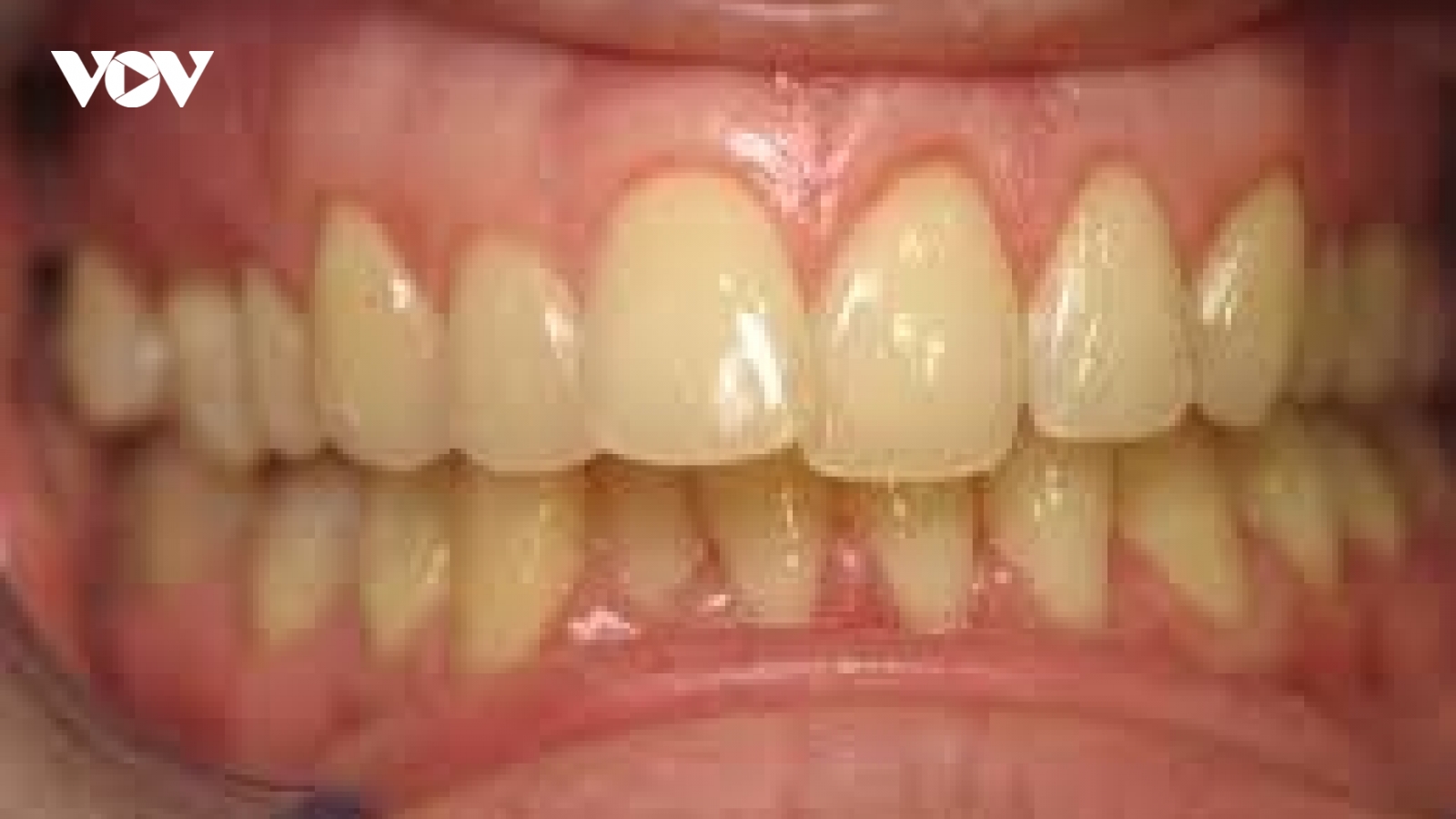 Răng cửa bị xỉn màu có đáng lo? Cách phòng tránh từ sớm