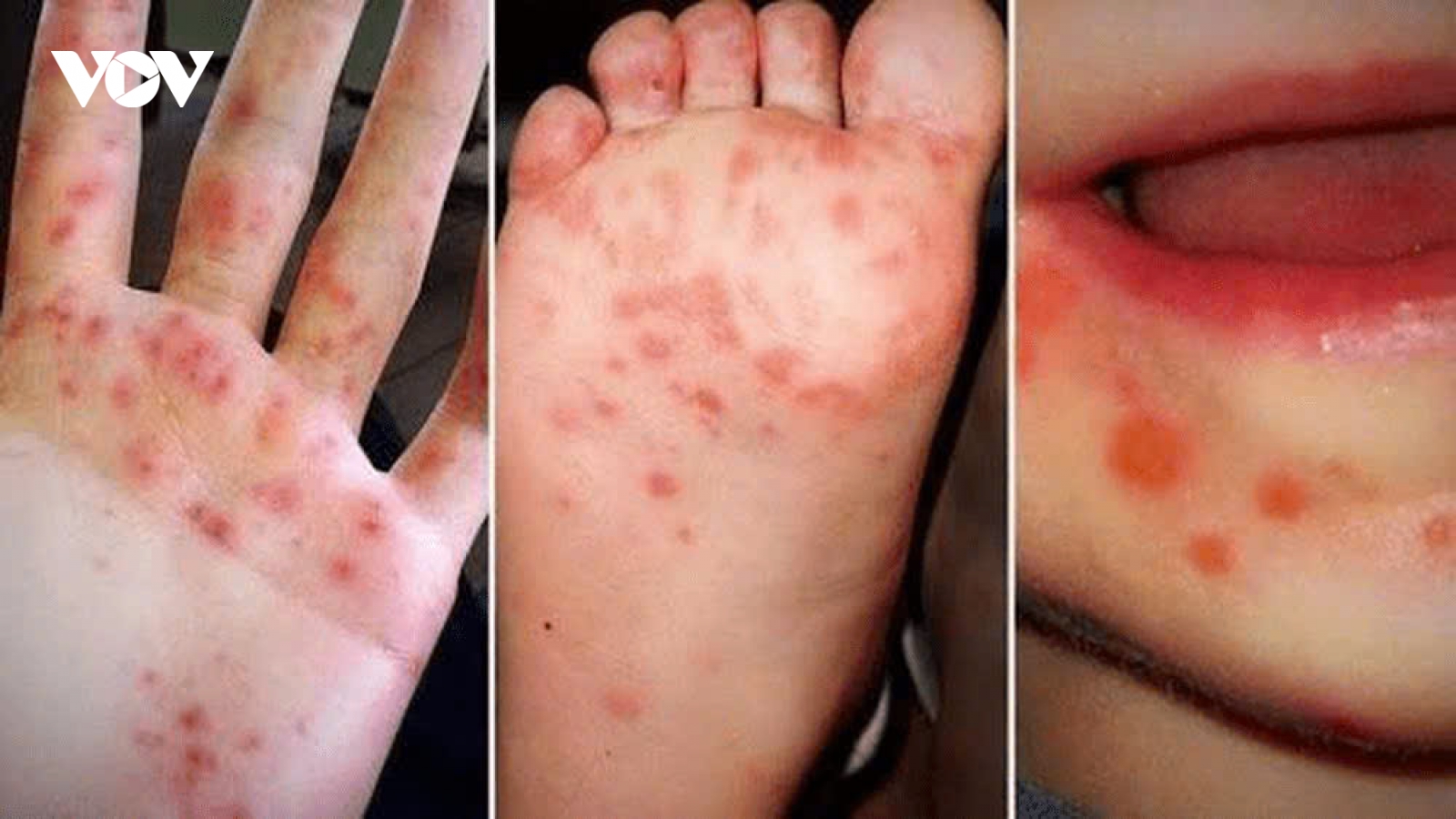 Bệnh tay chân miệng: Số ca bệnh nặng có thể tiếp tục gia tăng