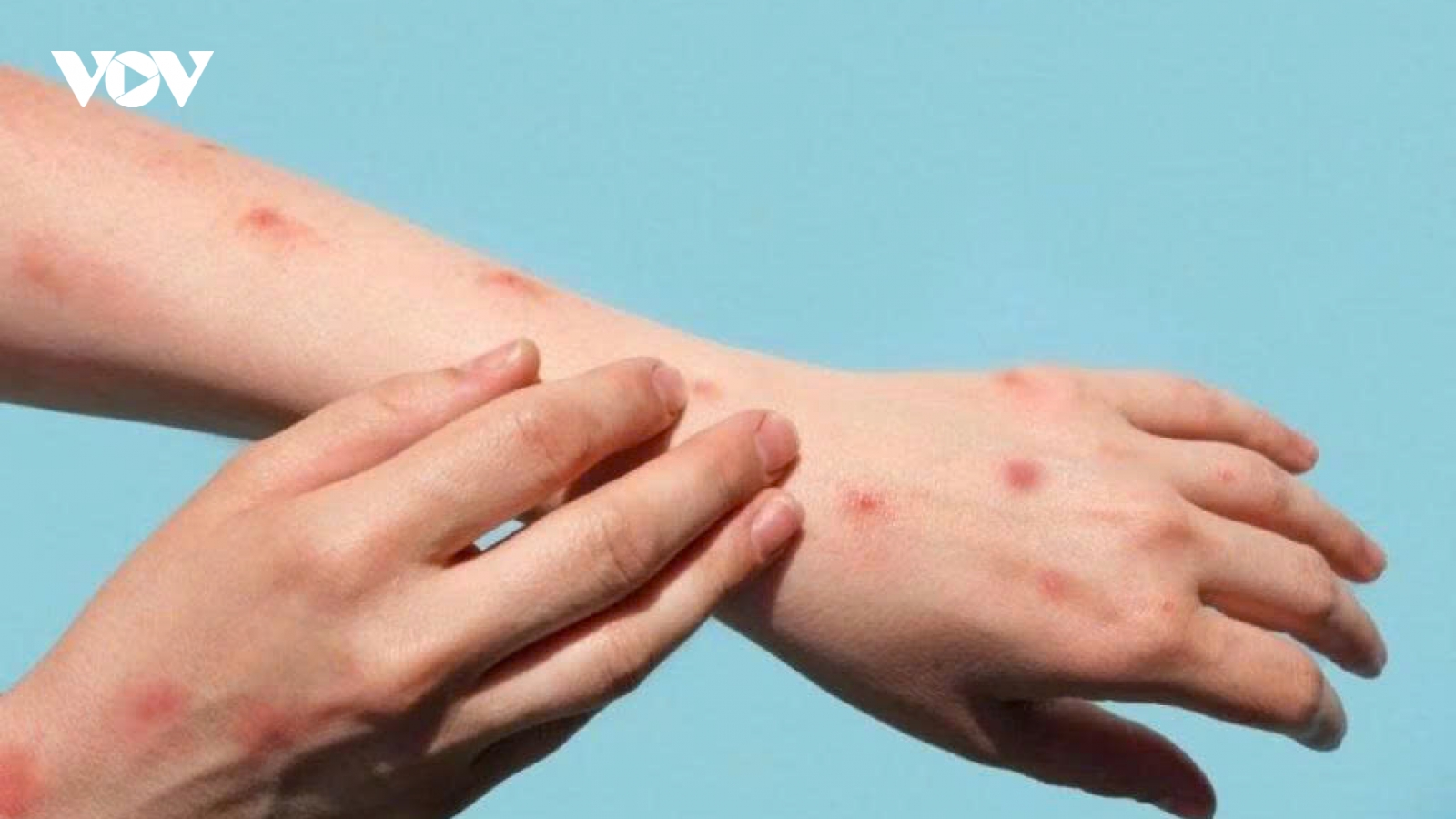 Thủy đậu tăng nhanh khi giao mùa: Làm gì để phòng bệnh hiệu quả?