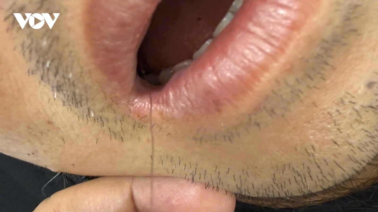 Hy hữu: Nhập viện cấp cứu vì lưỡi câu nằm ngang thực quản sau khi ăn cá