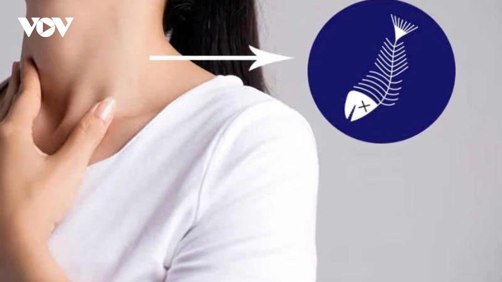 Hóc xương cá kéo dài nguy hiểm thế nào?