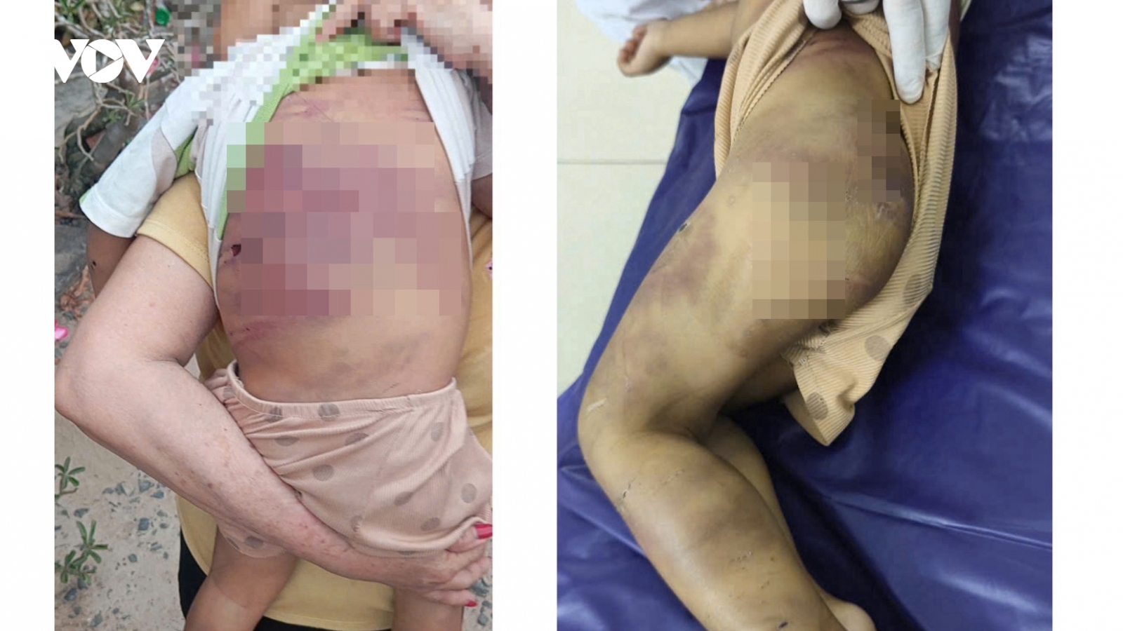 Bắt khẩn cấp “vợ chồng hờ” bạo hành, khiến bé trai 2 tuổi nguy kịch