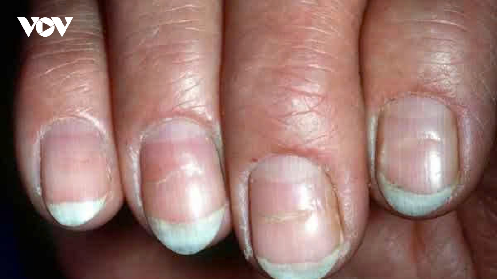 Nhìn móng tay biết bệnh? 6 dấu hiệu cảnh báo sức khỏe bạn không nên bỏ qua