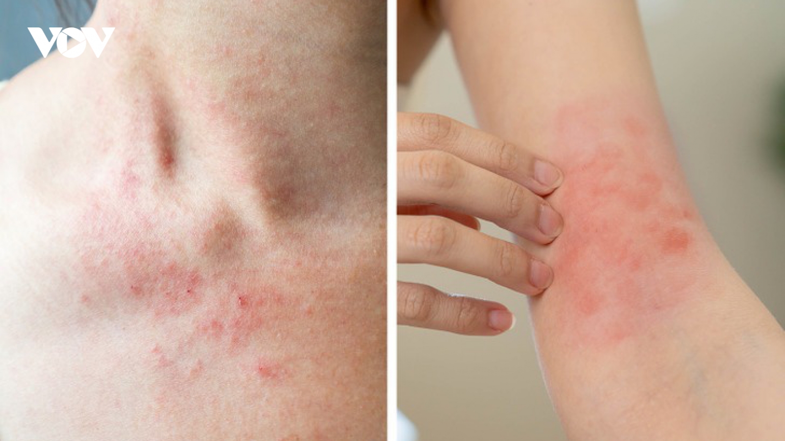 Thấy da có 6 dấu hiệu này, nên đi khám sức khỏe càng sớm càng tốt