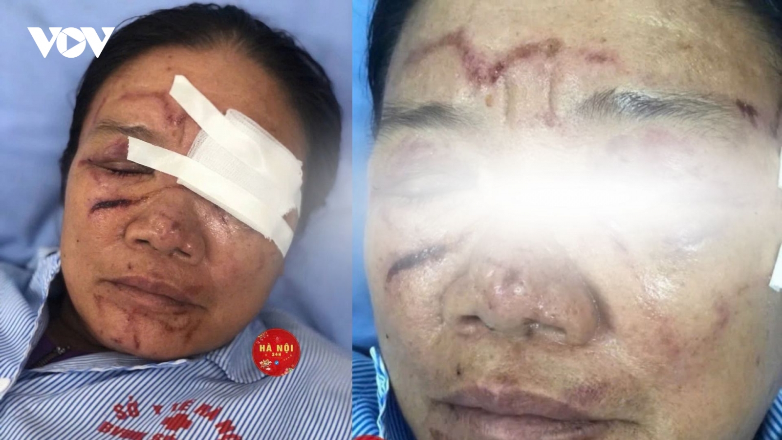 Vụ tiểu thương bị xịt nước chảy máu mắt ở Phú Thọ: Diễn biến sức khỏe ra sao?