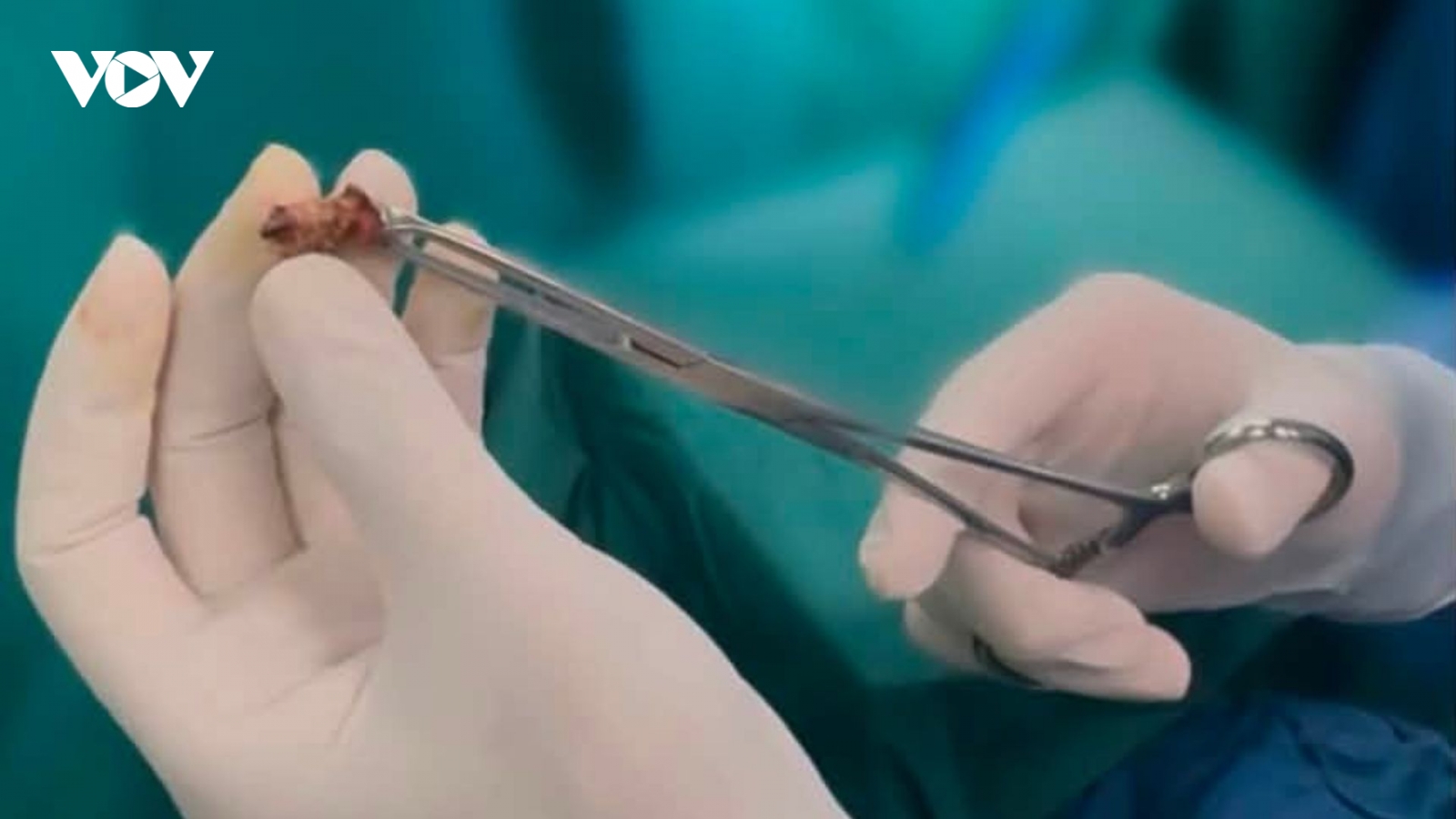 Chữa bệnh trĩ theo quảng cáo, người đàn ông U70 nhập viện vì biến chứng nặng