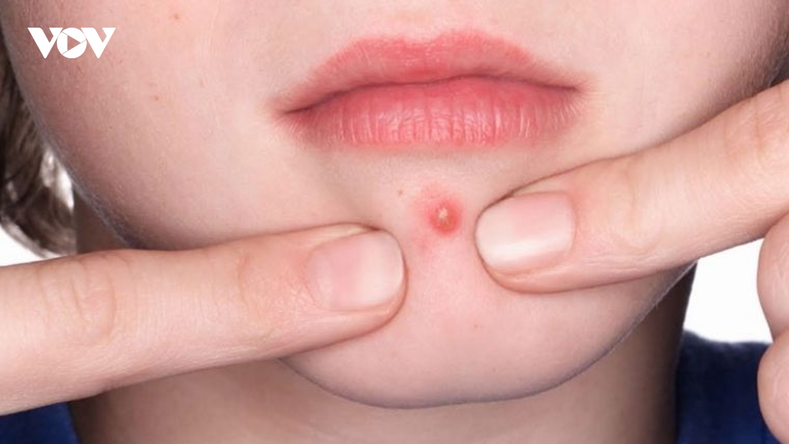 Nặn mụn xong bị sưng tấy, làm sao để da nhanh hồi phục?