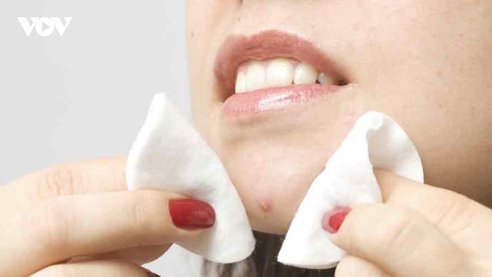 Không nặn mụn nhưng vẫn bị rỗ mặt, vì sao?