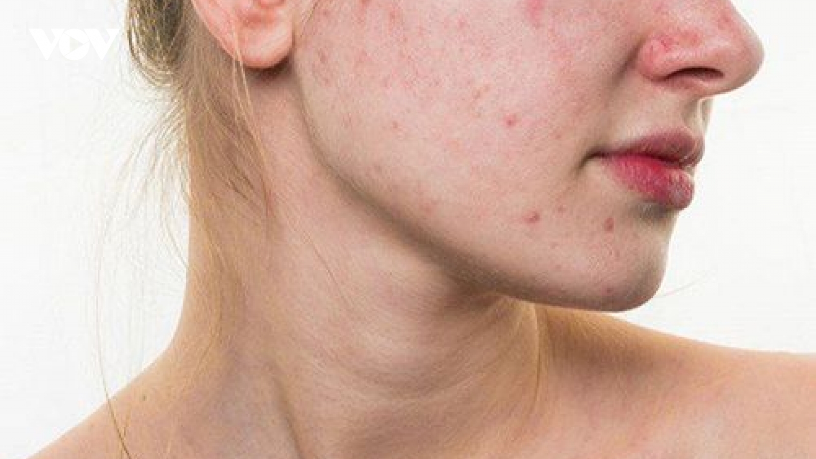 Bí quyết tẩy da chết giúp da mụn thông thoáng, giảm nguy cơ nổi mụn