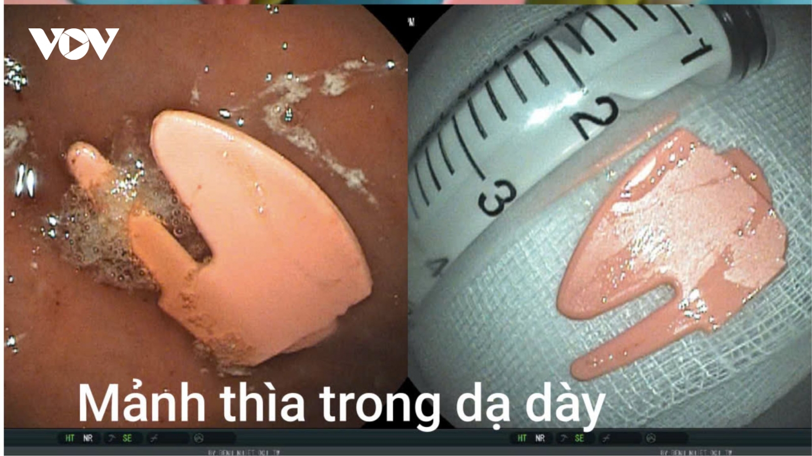 Tự xúc ăn sữa chua, bé 20 tháng tuổi nuốt mảnh thìa nhựa gãy vào dạ dày