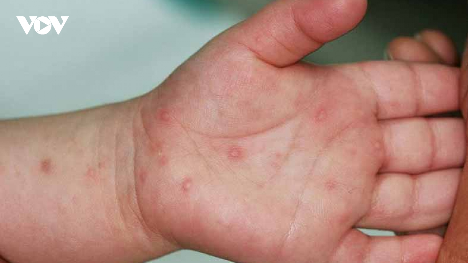 Cả nước ghi nhận hơn 3.000 ca tay chân miệng mỗi tuần, Bộ Y tế cảnh báo