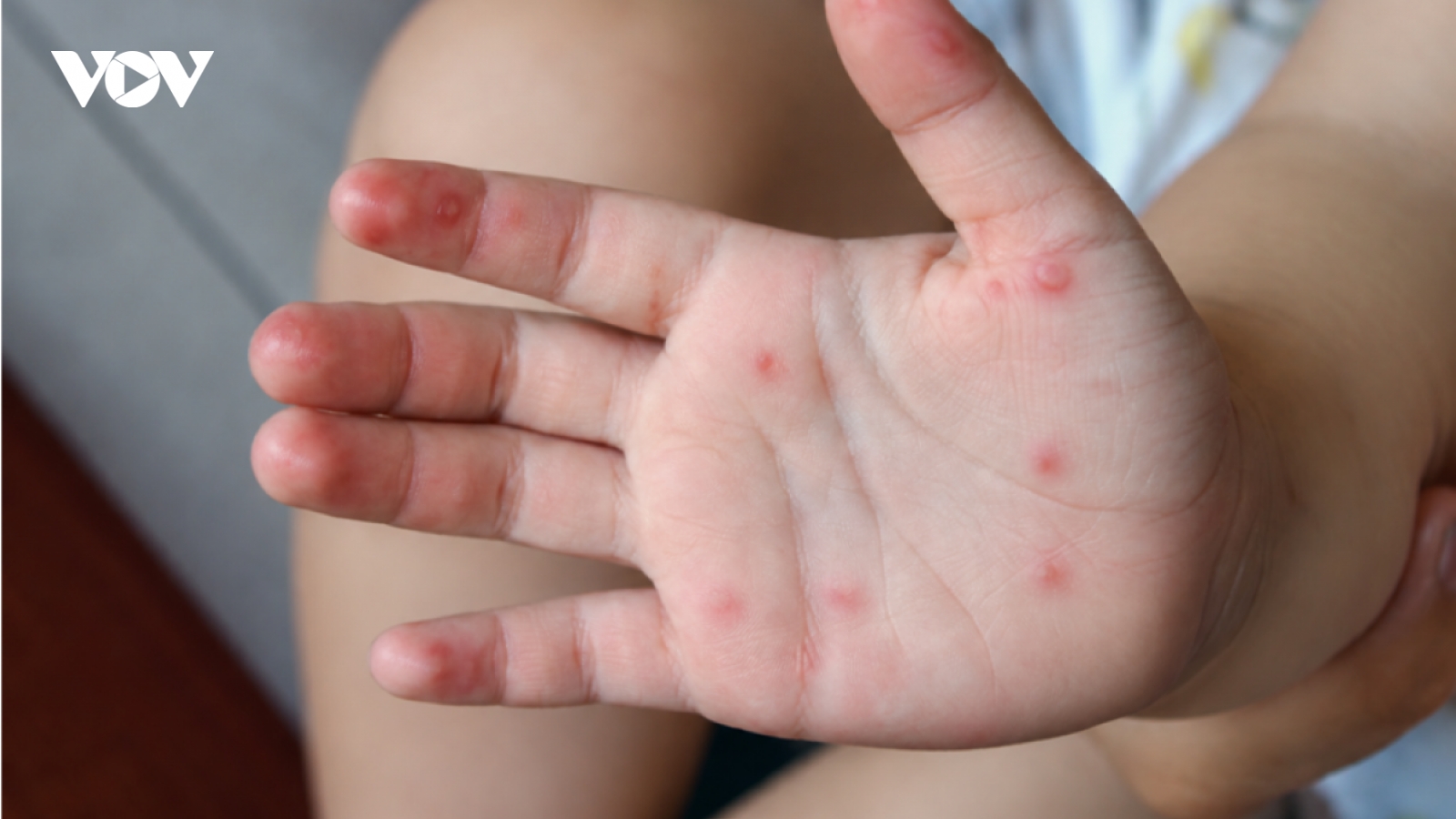 Gần 1.000 ca tay chân miệng – làm sao để bảo vệ trẻ nhỏ trong năm học mới