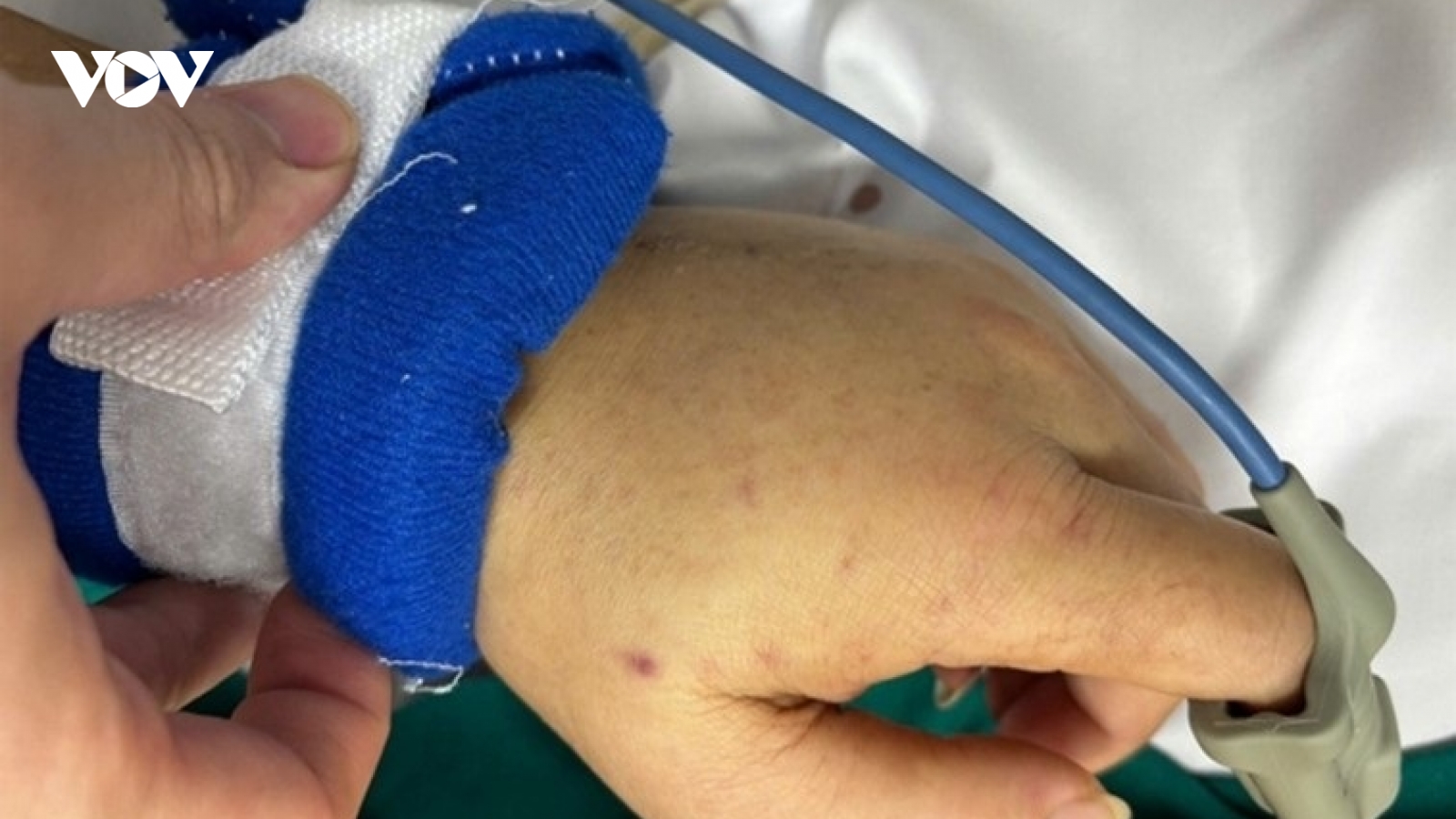 Người trưởng thành chưa tiêm vaccine não mô cầu có nguy cơ mắc bệnh ra sao?