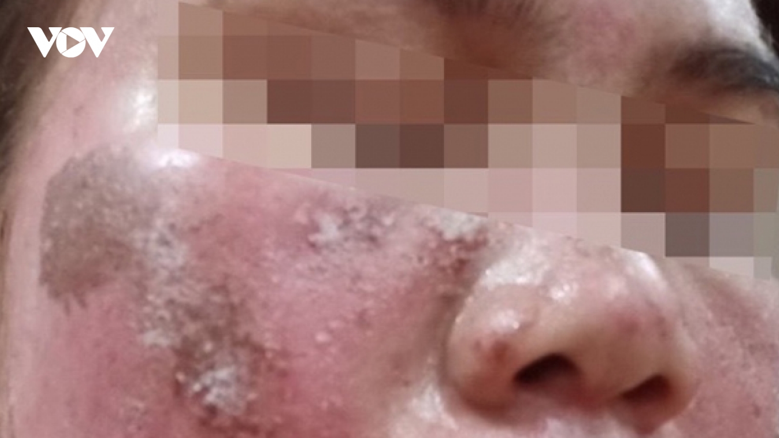Mặt bỏng rát, bong tróc như da rắn sau khi bôi thuốc tại spa