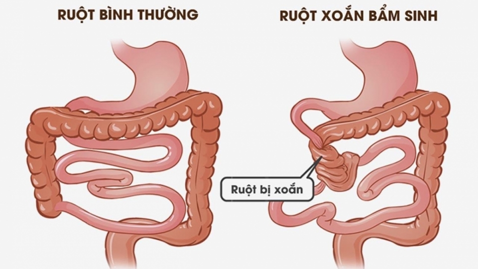 benh-xoan-ruot-o-tre.jpg