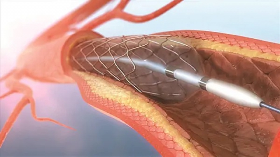 Kiêng cữ sinh hoạt vợ chồng thế nào sau khi đặt stent?