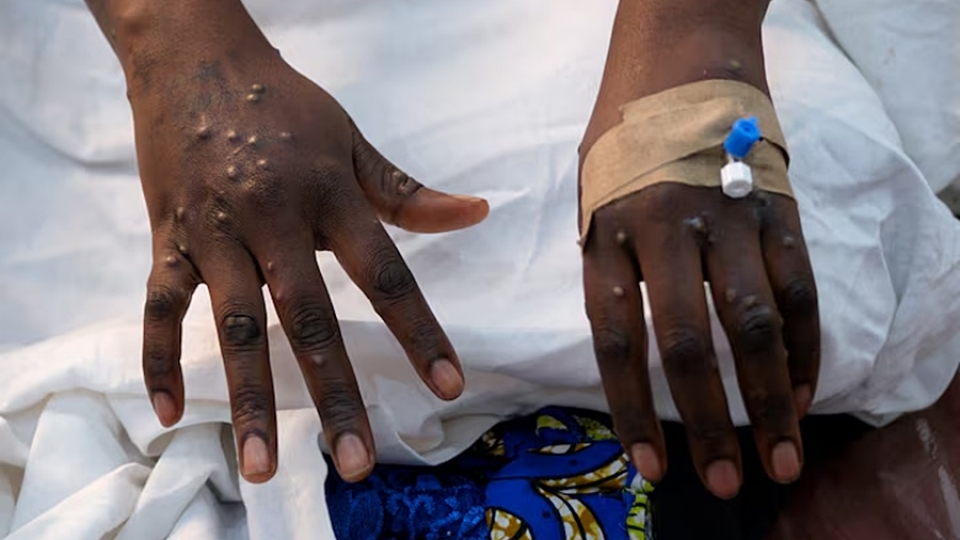 benh dau mua khi, mpox, virus dau mua khi -reu.jpg
