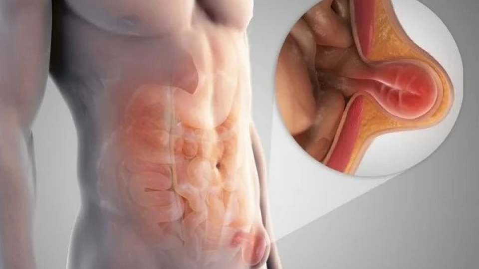Những triệu chứng của bệnh thoát vị bẹn ở người cao tuổi cần lưu ý